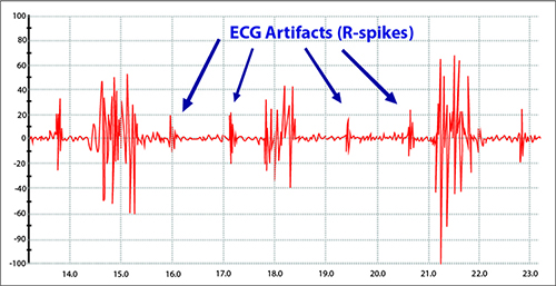 ECG artifacts
