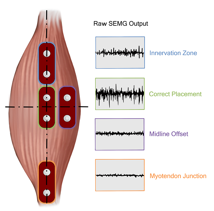 Correct and incorrect EMG sensor placement