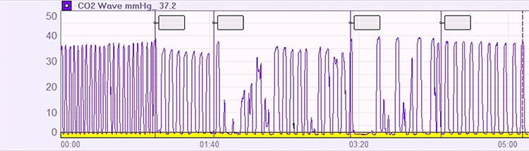 Capnometer display showing effort effects