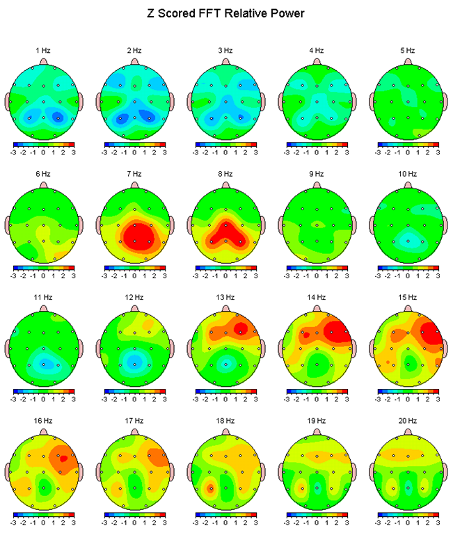 Z-score based qEEG map