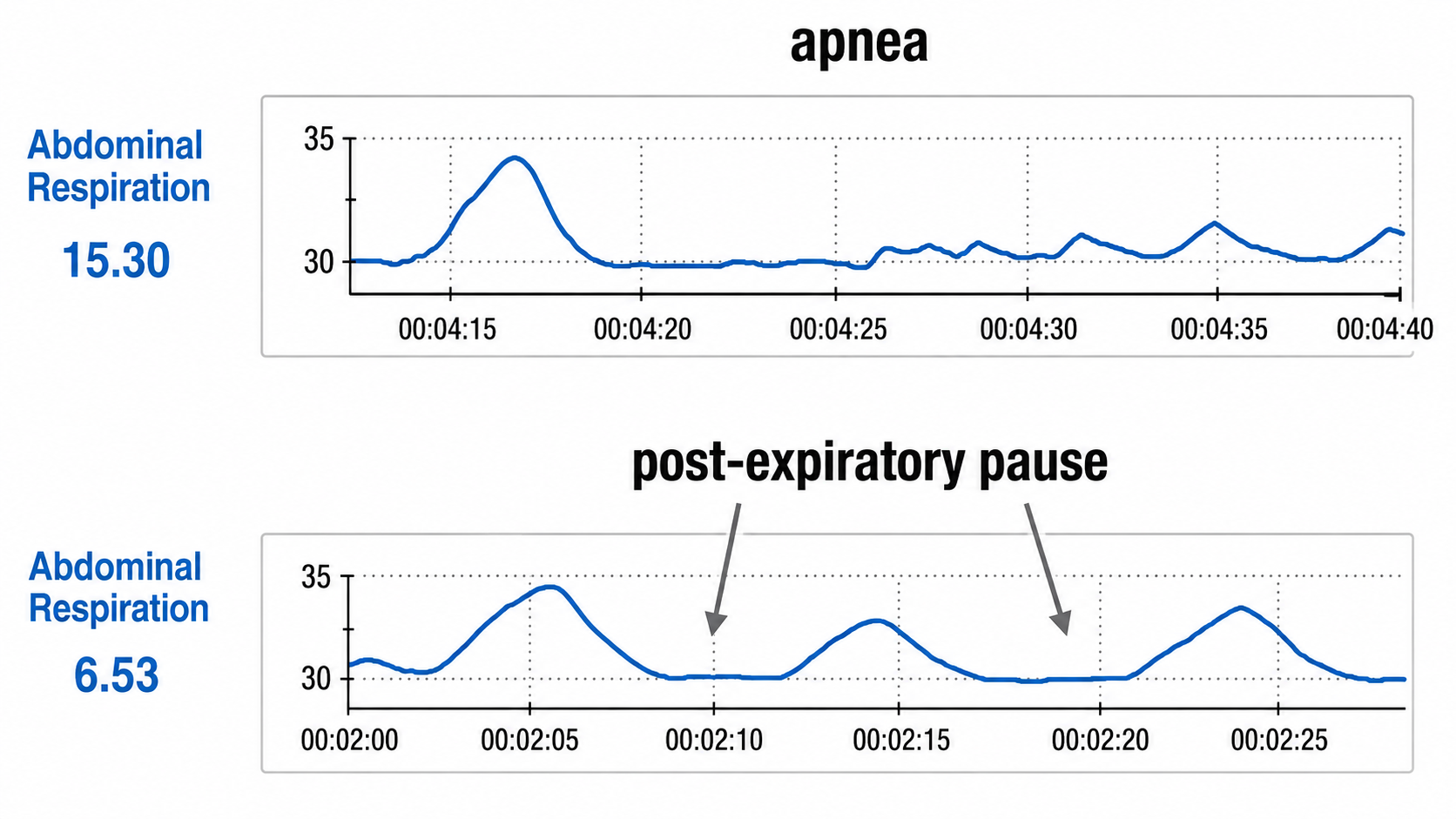 Apnea vs pause