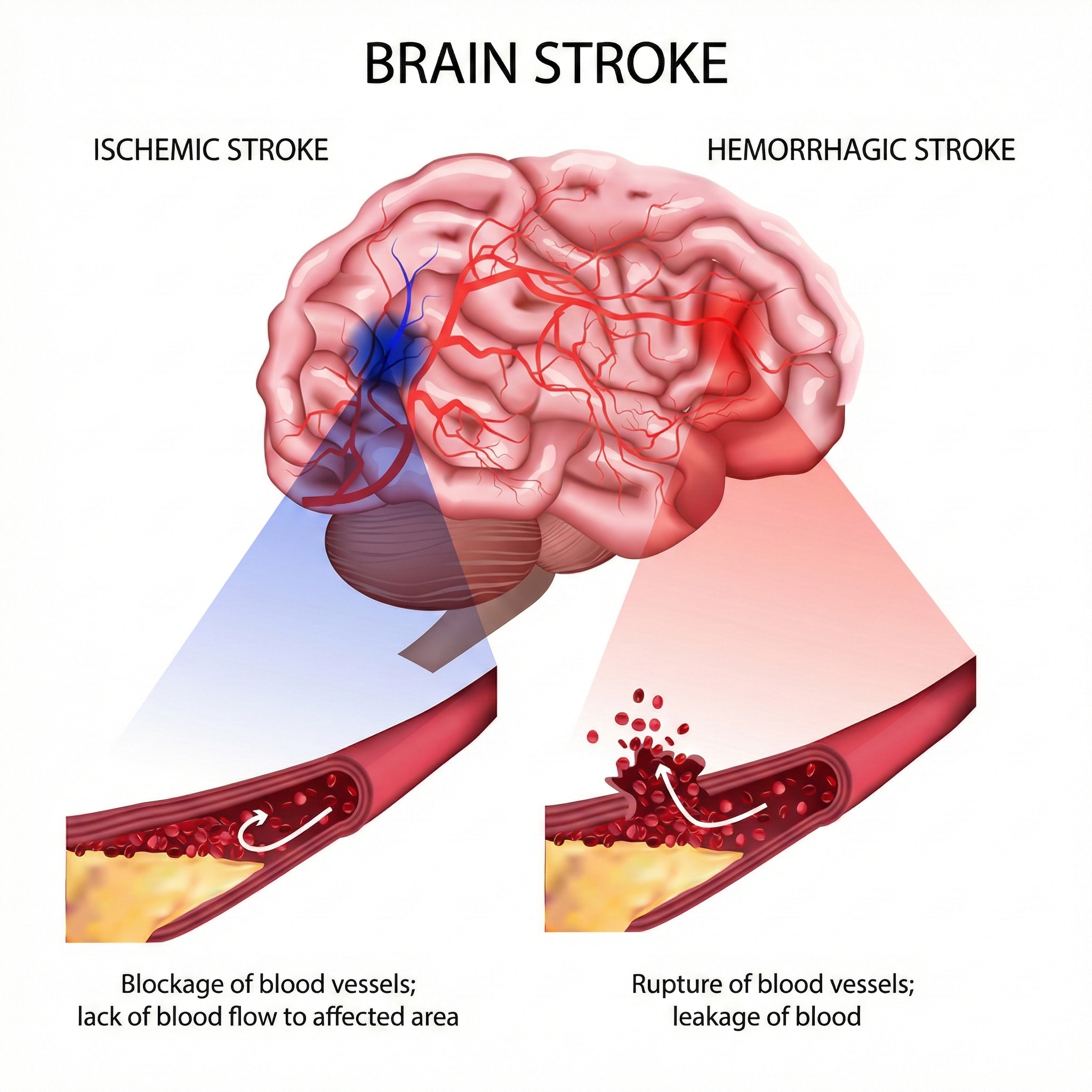 Types of stroke illustration