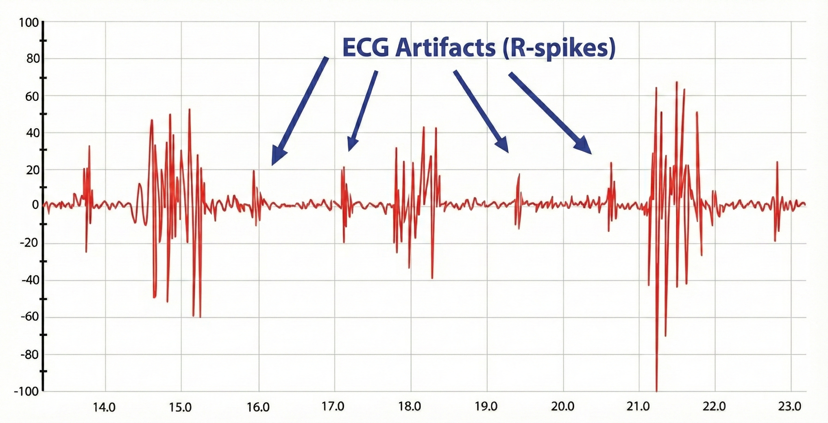 ECG artifact in SEMG signal