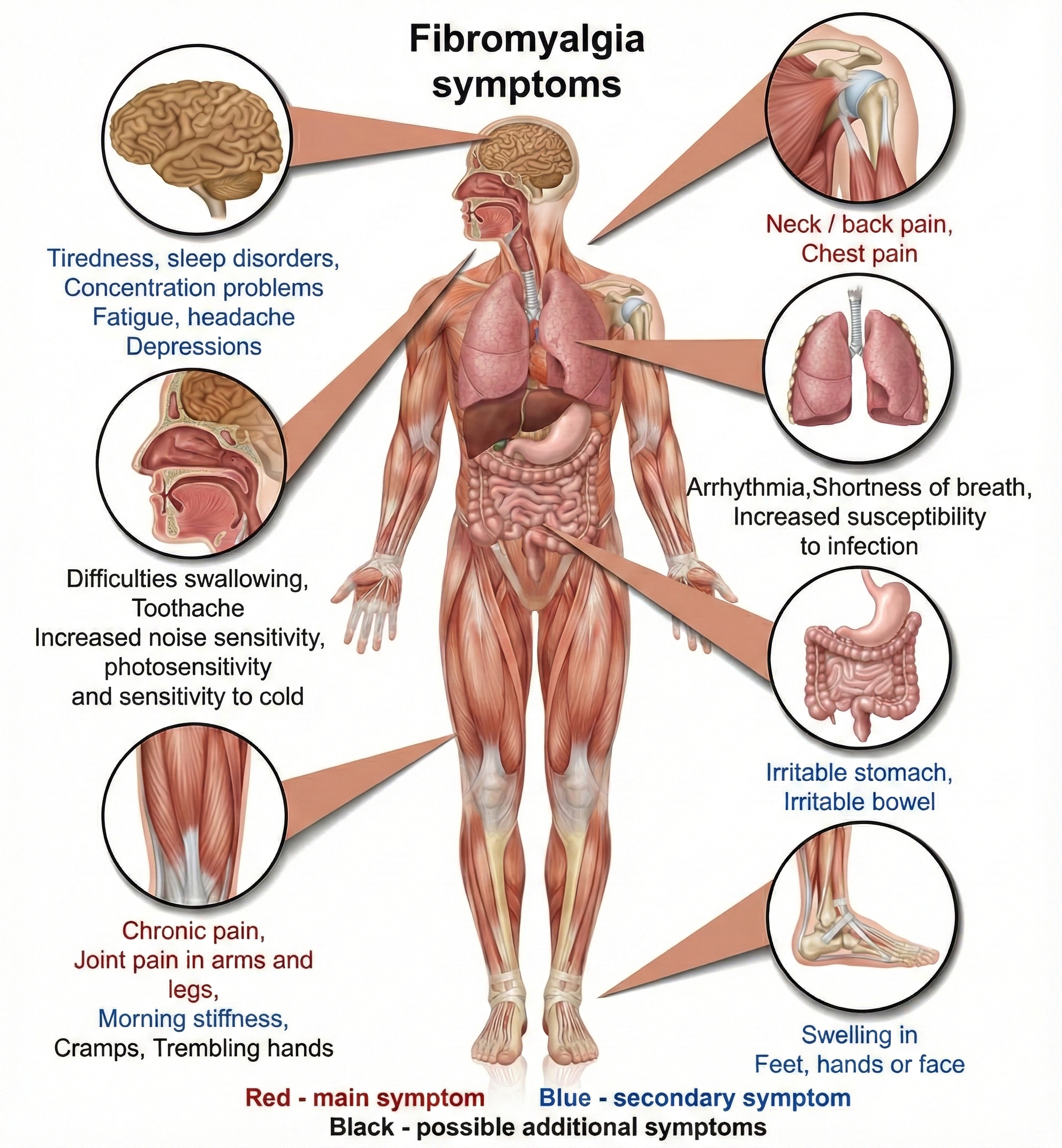 Fibromyalgia pain points diagram