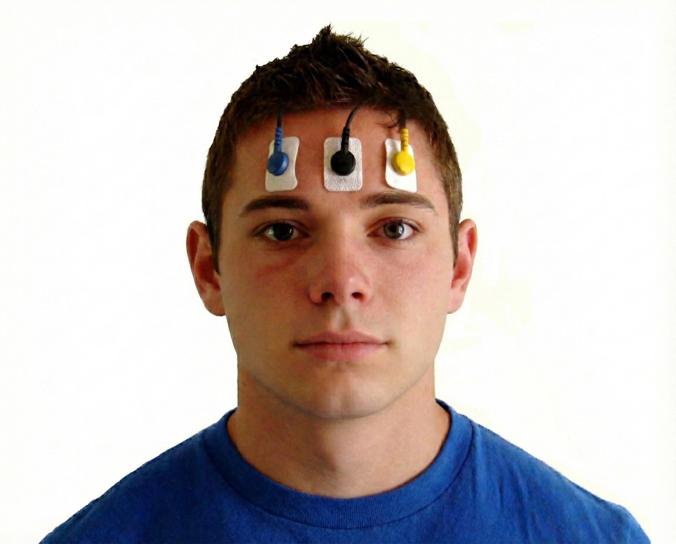 Bipolar frontal EMG placement
