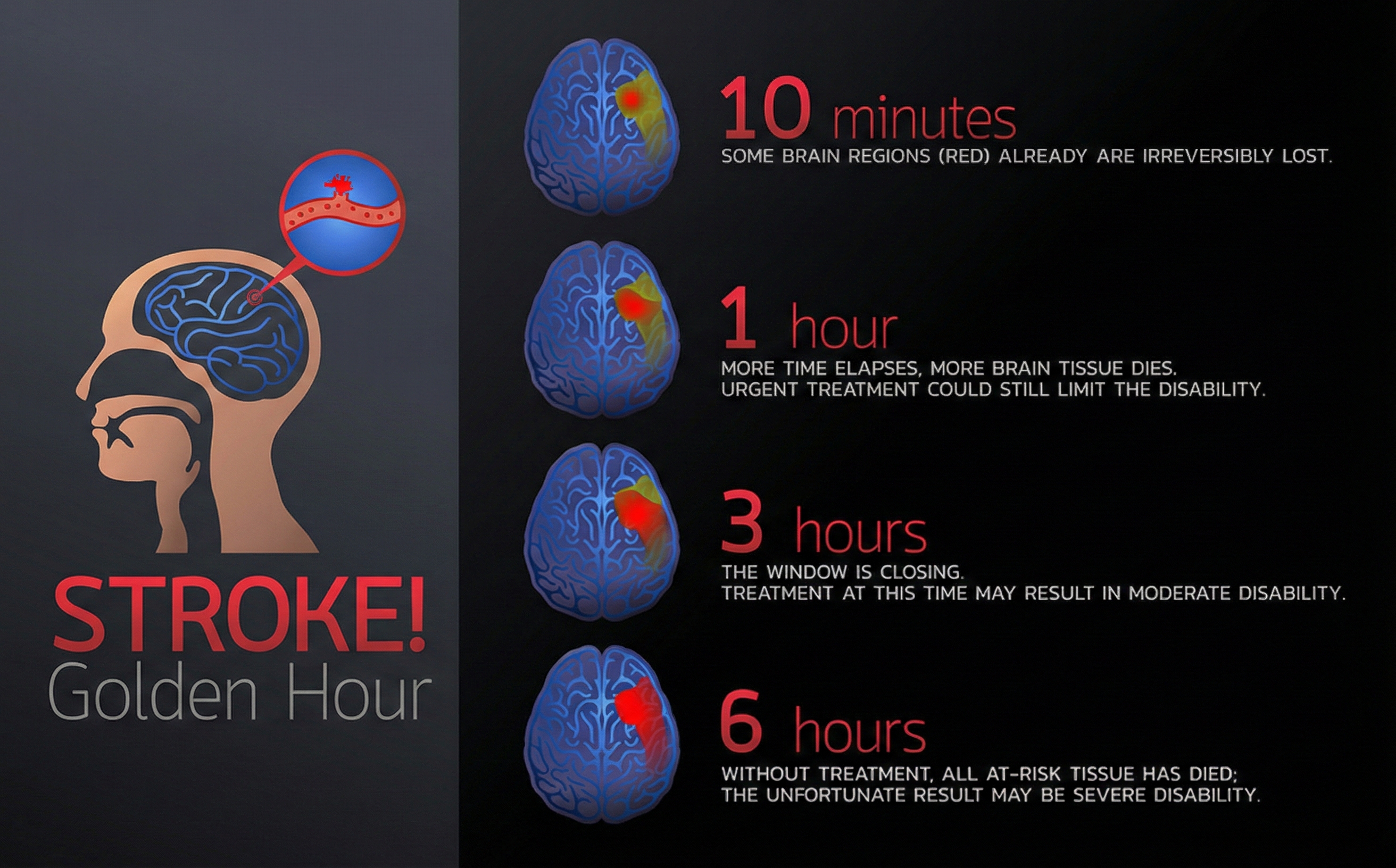 Golden hour concept for stroke