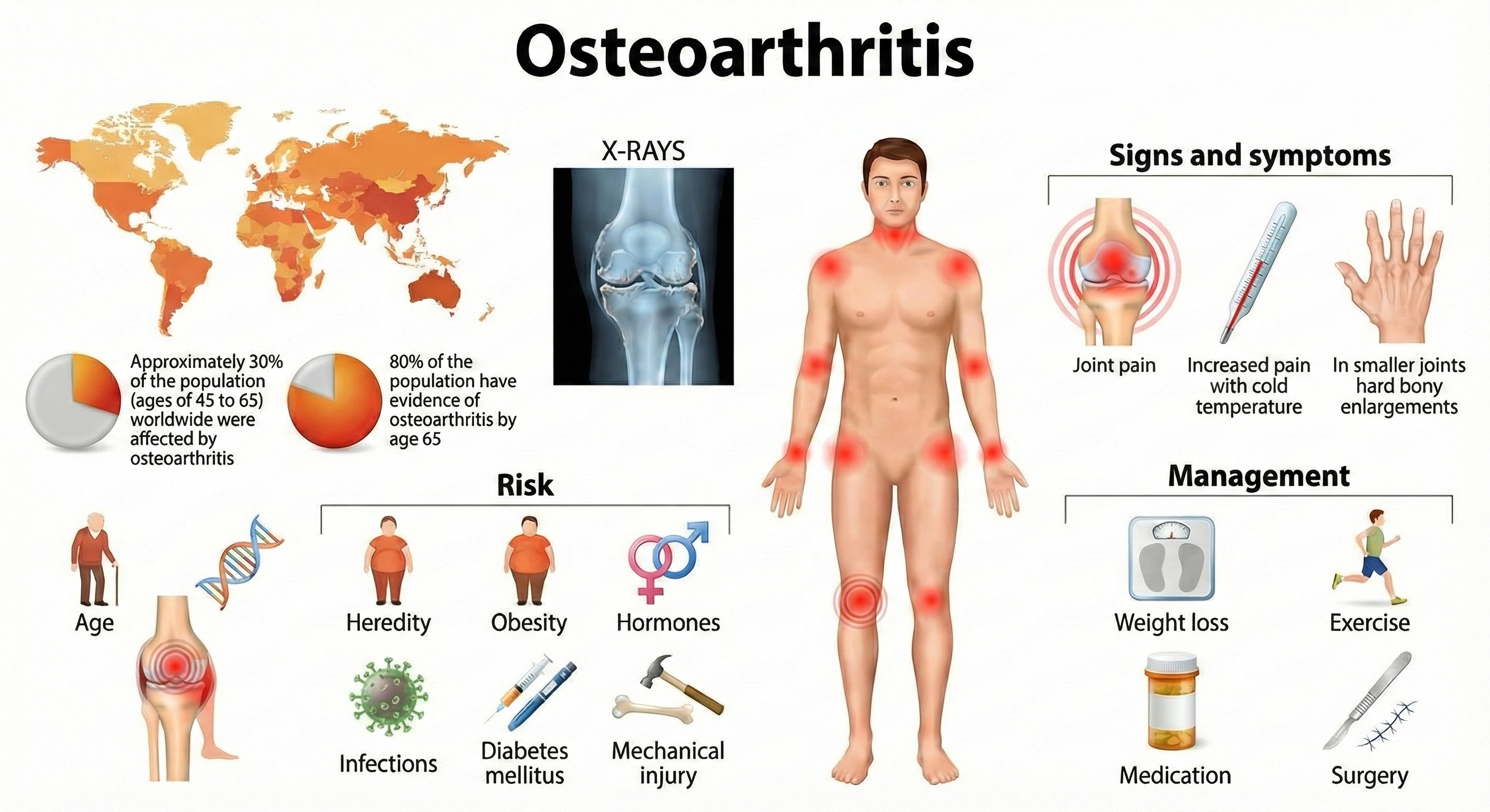 Osteoarthritis illustration