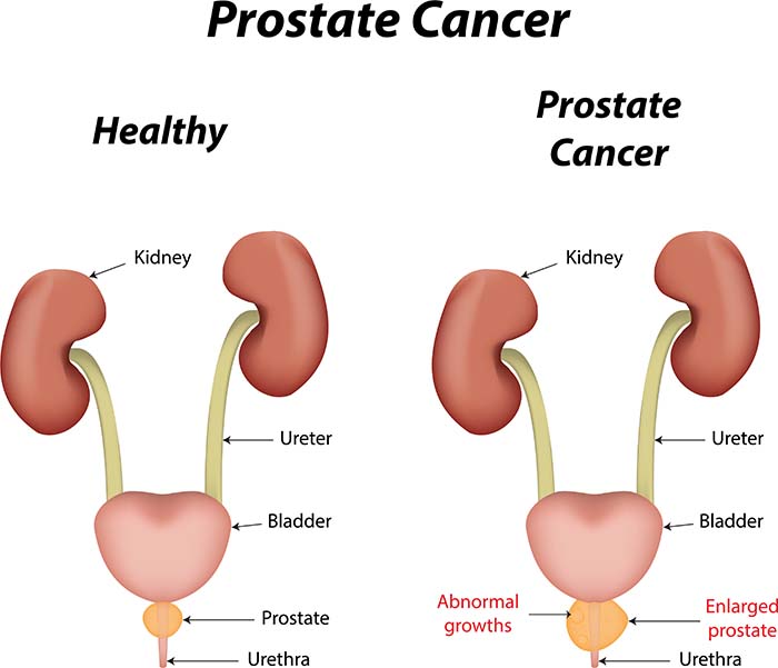 Prostate cancer illustration