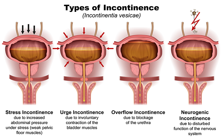 Types of urinary incontinence
