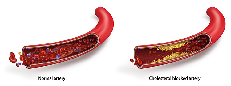 Normal and blocked arteries
