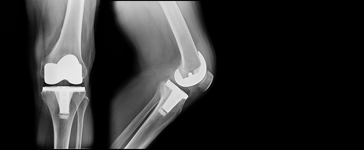 Total knee replacement illustration