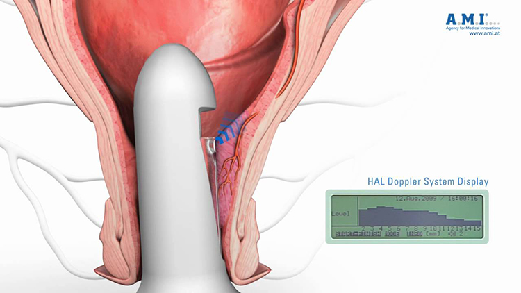 Transanal ultrasound system