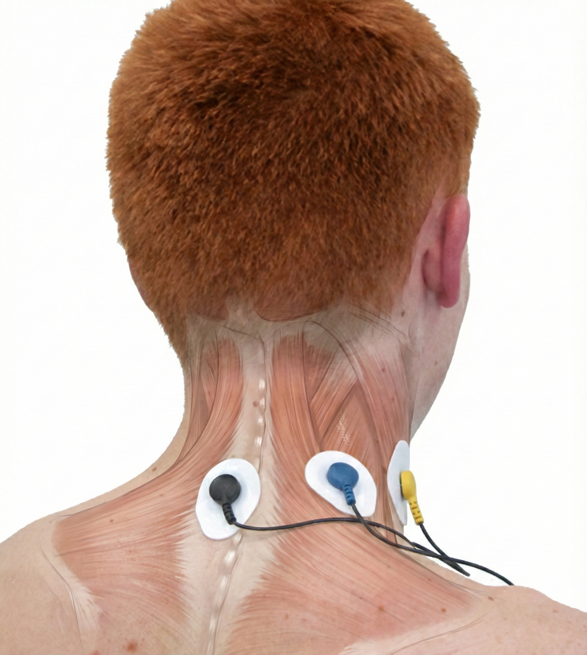 Trapezius and scalene electrode placement