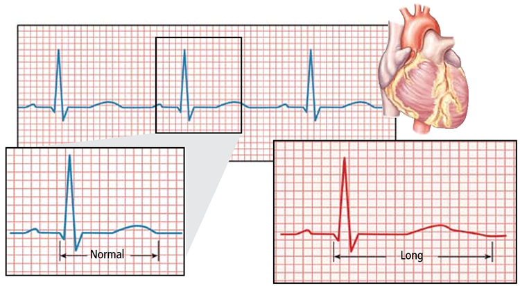 Prolonged QT interval