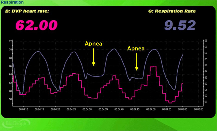 apnea