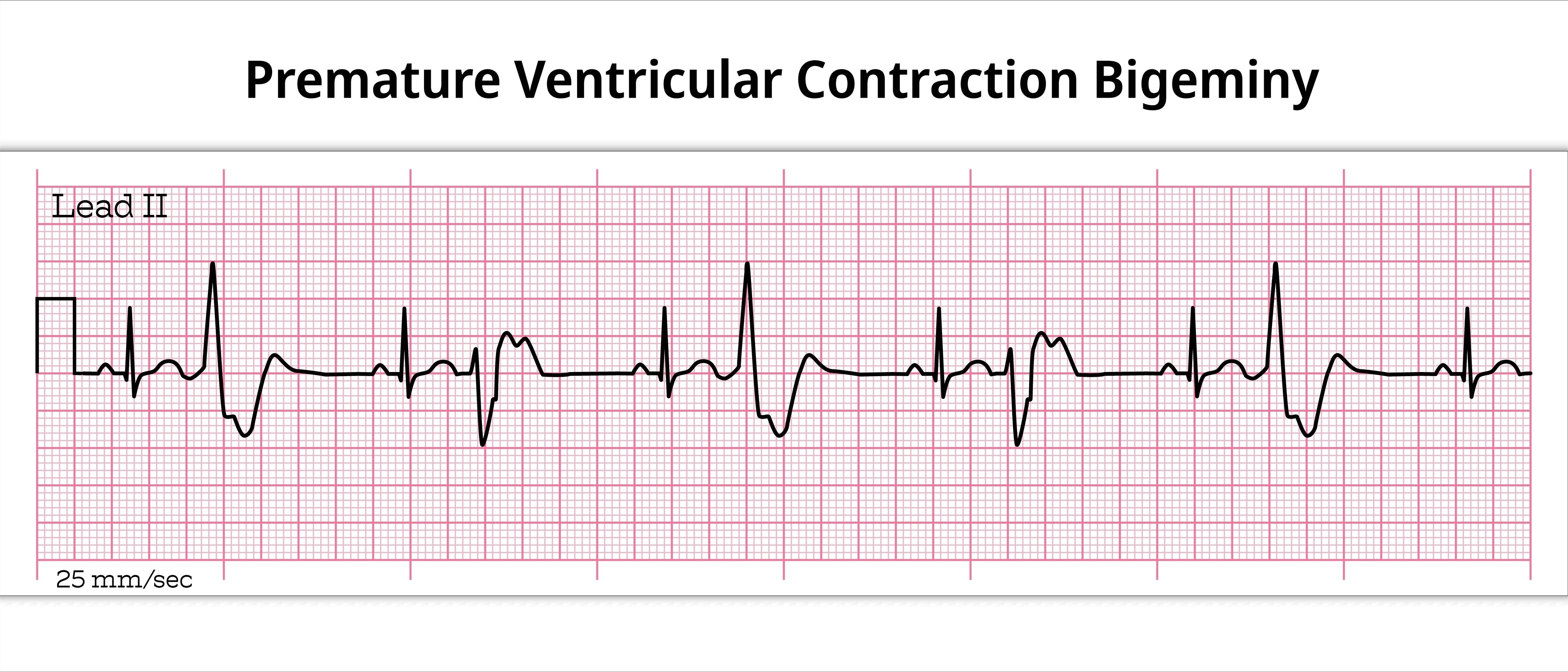 ECG strip showing bigeminy