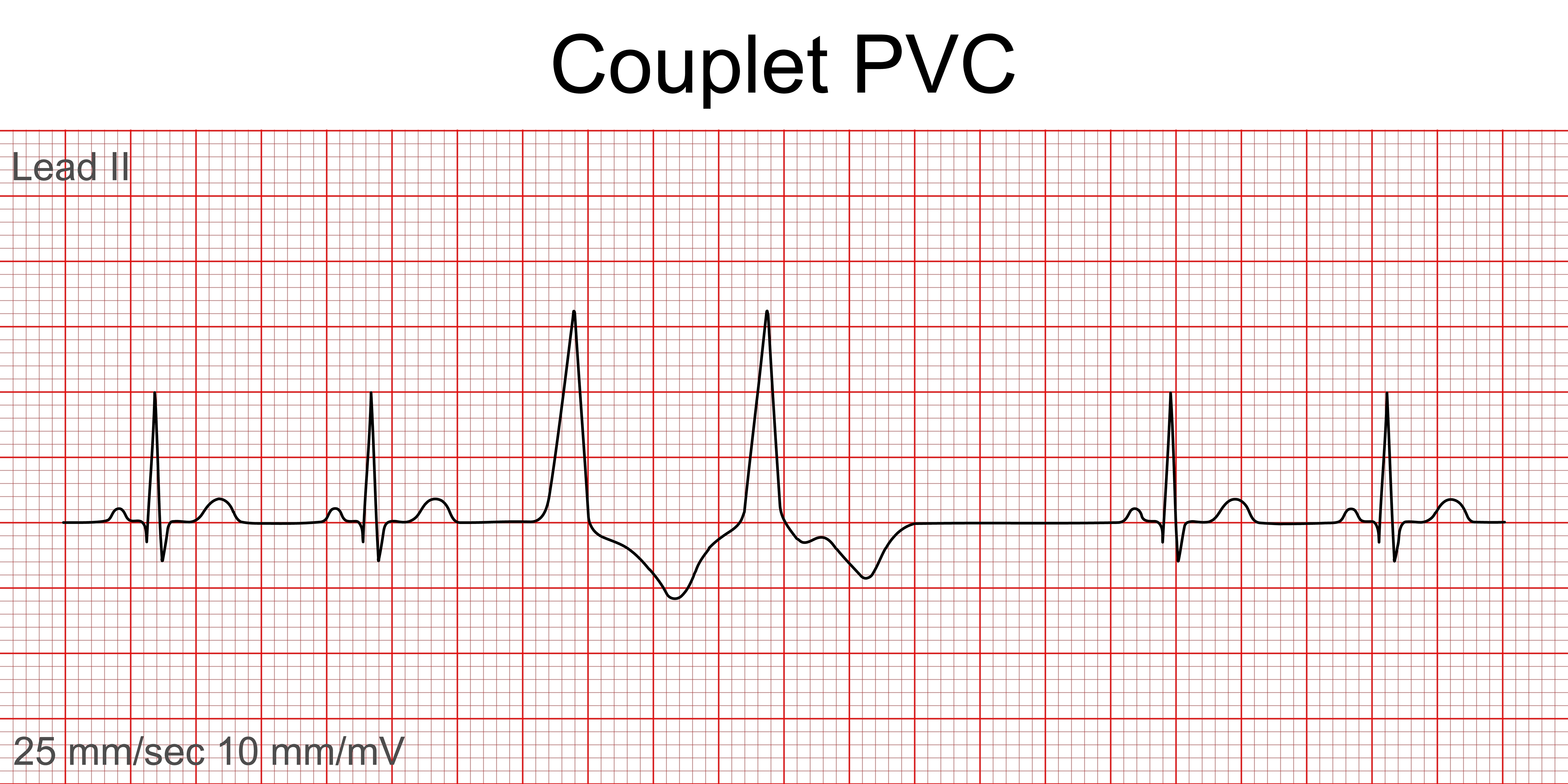 ECG strip showing trigeminy