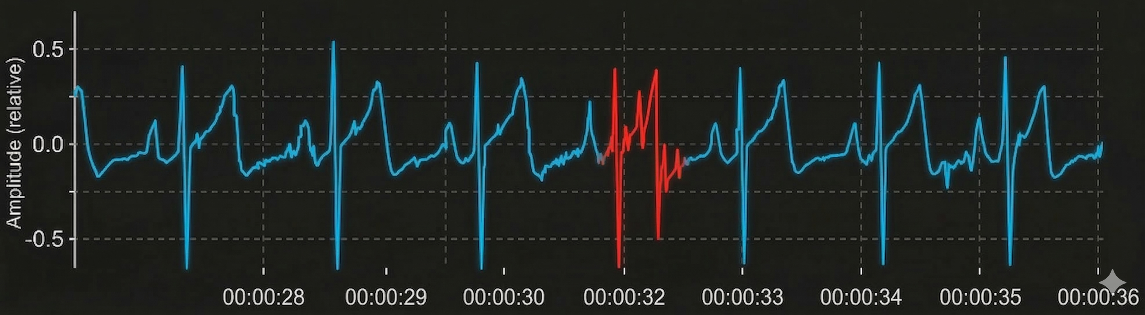 Short IBI caused by extra beat