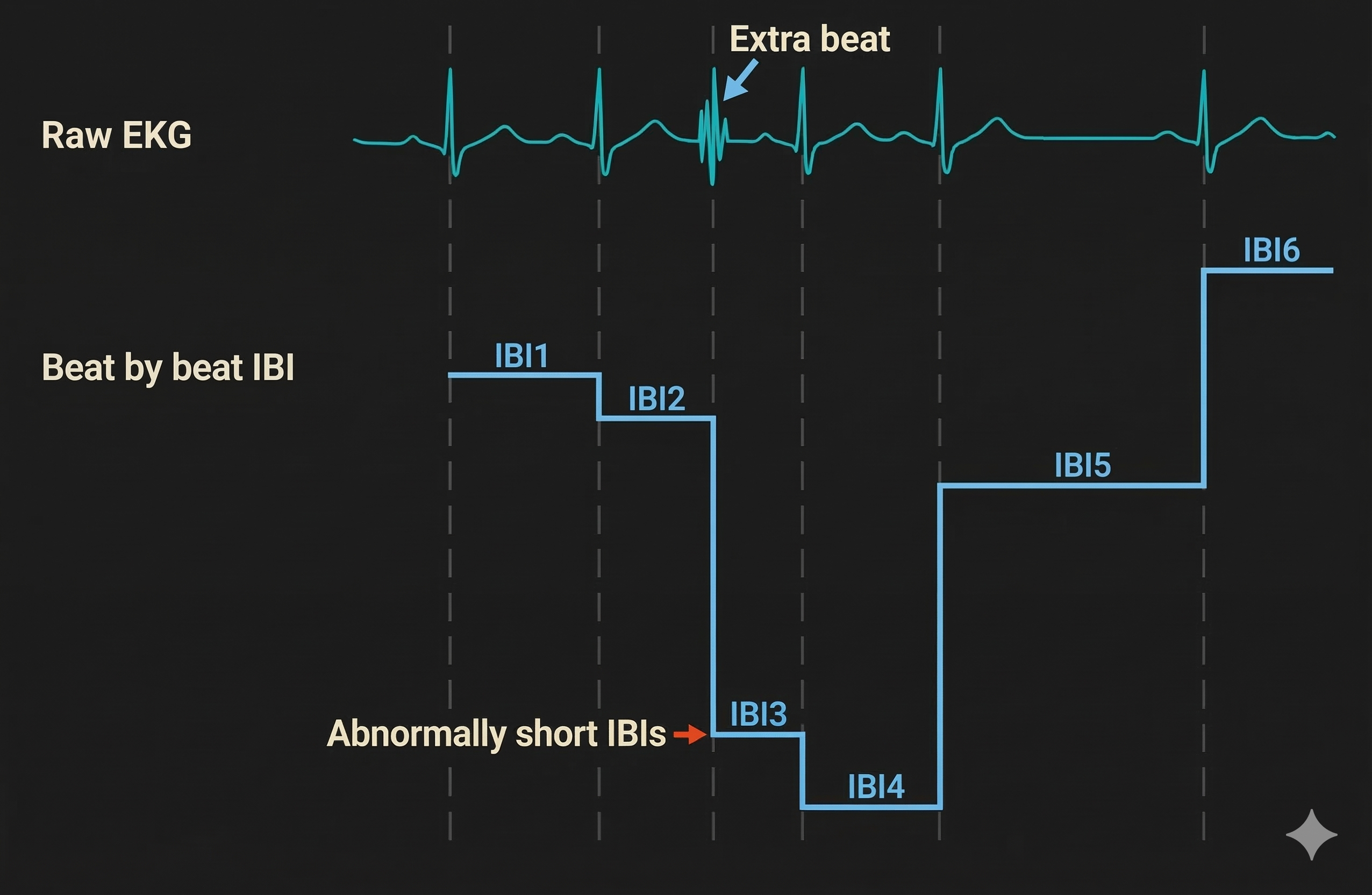 Extra beats shortening IBIs