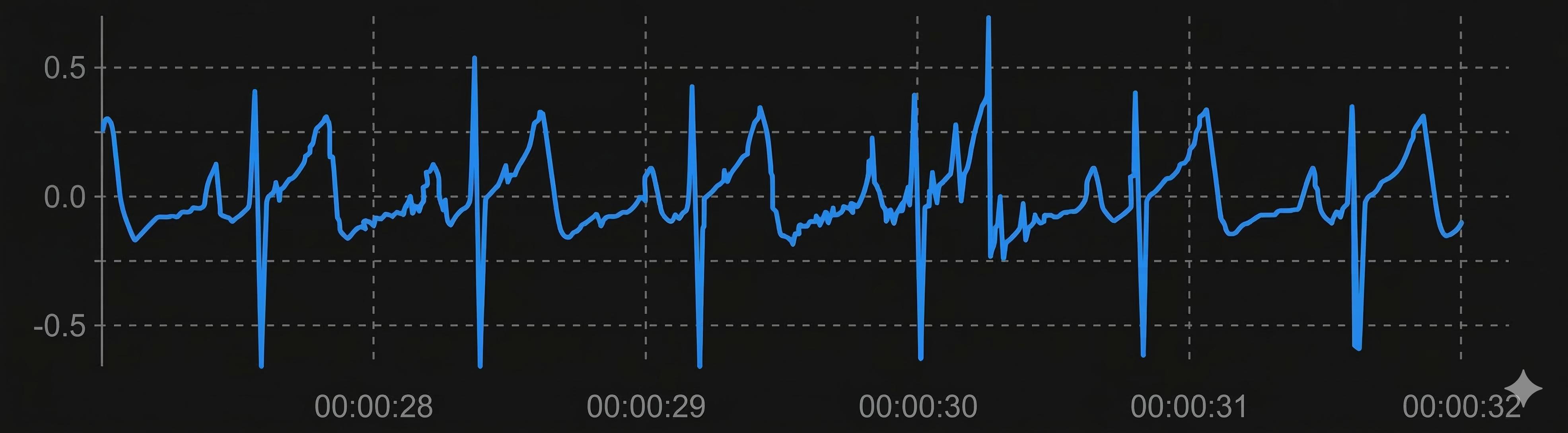 Long IBI caused by missed beat