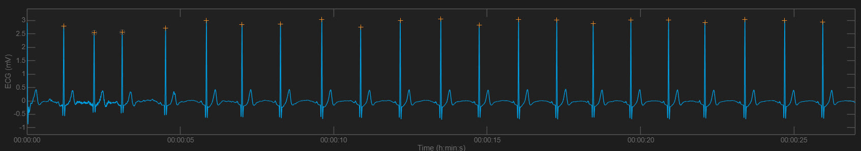 ECG signal with R-spike detection