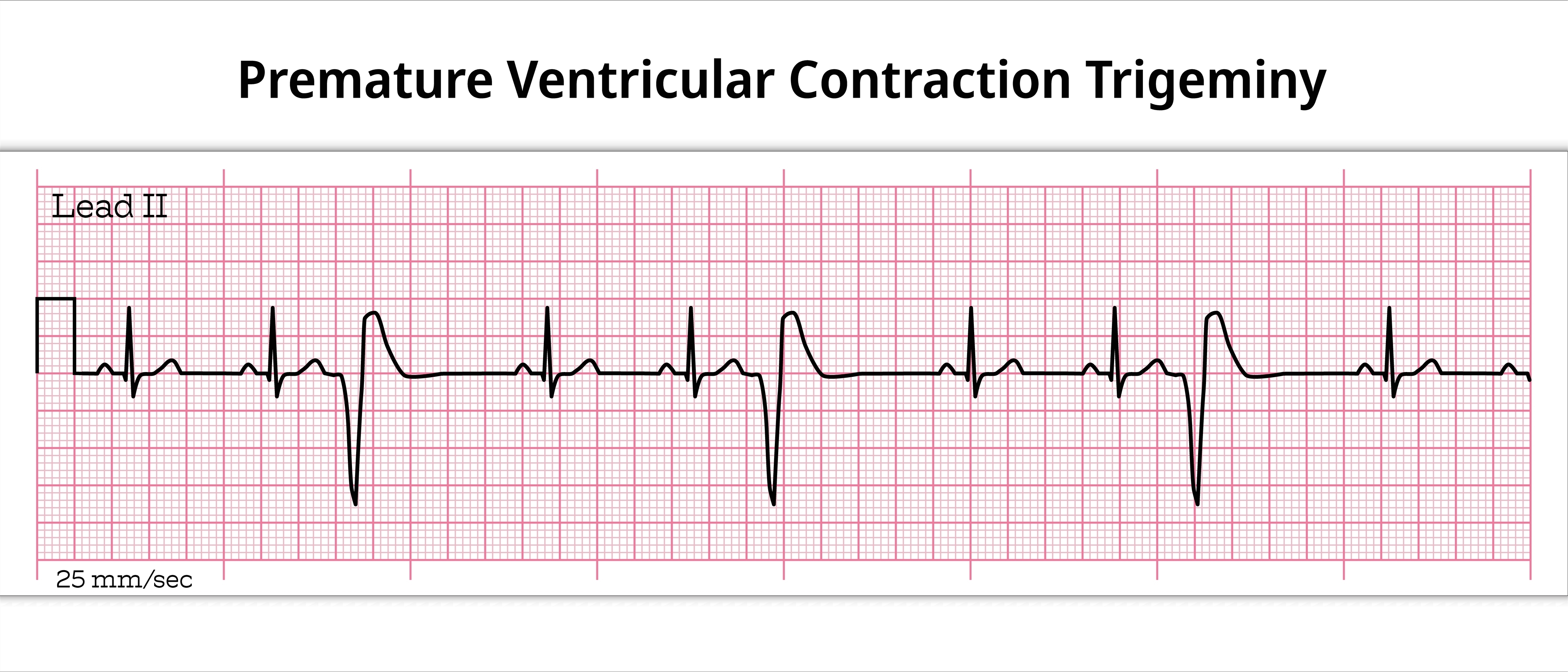 ECG strip showing trigeminy