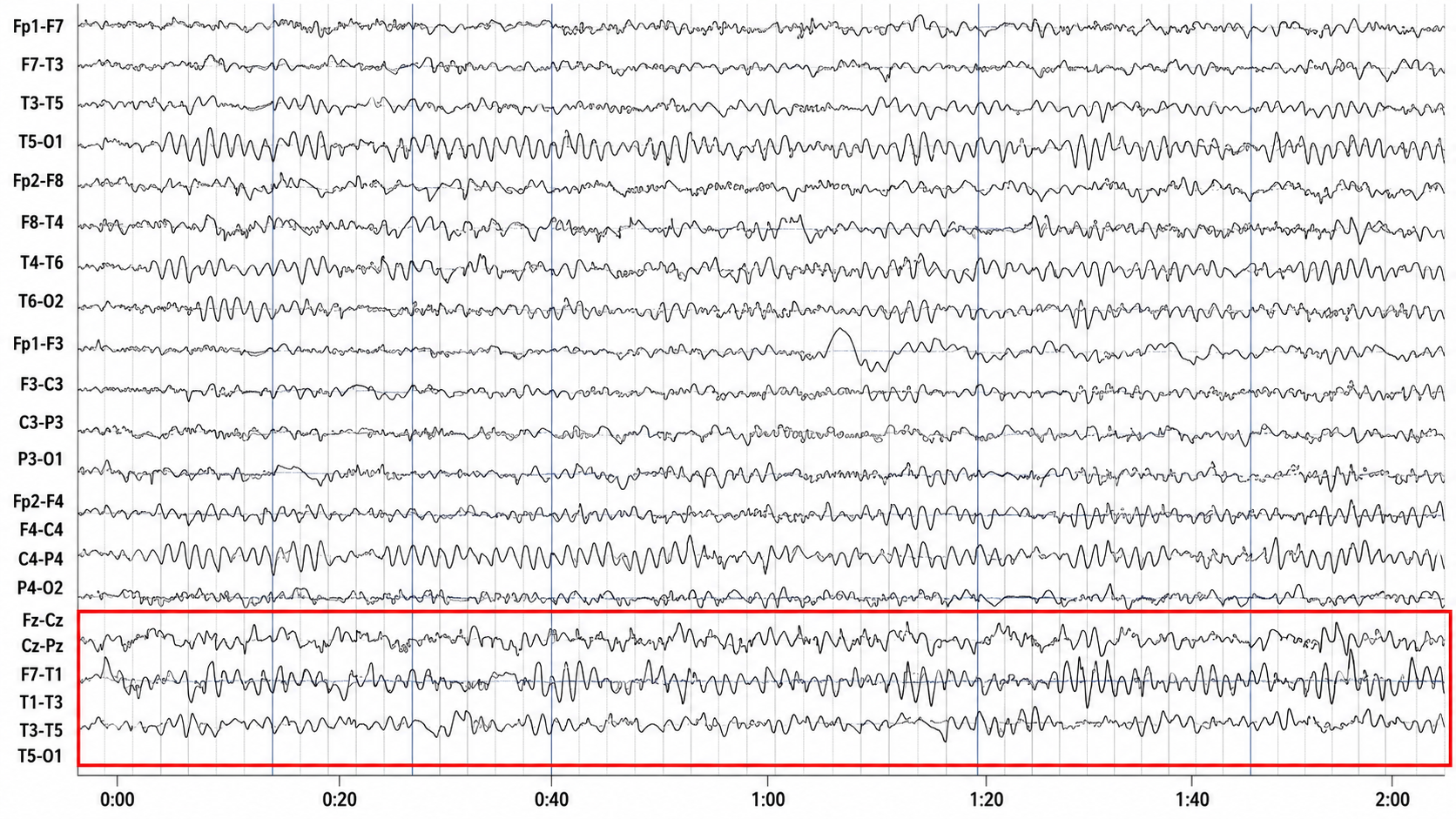 Compressed two-minute EEG display with a red box around midline and anterior-temporal channels showing a sustained left temporal rhythmic discharge