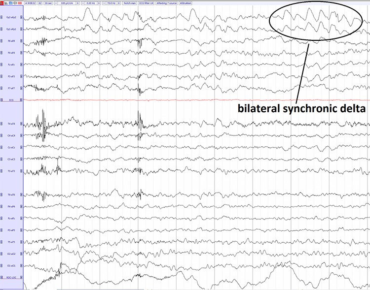 EEG recording showing hyperventilation-induced slowing