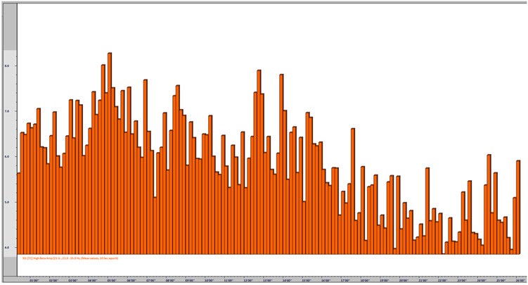 Graph showing high beta amplitude decreasing across the neurofeedback session over approximately 26 minutes
