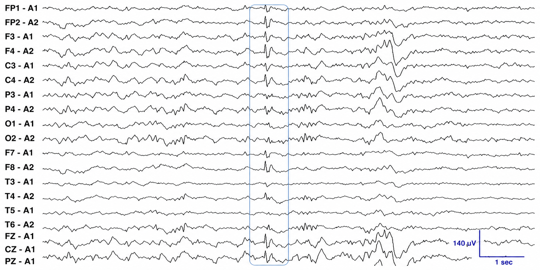 Ear-referenced EEG montage with a boxed benign epileptiform transient of sleep