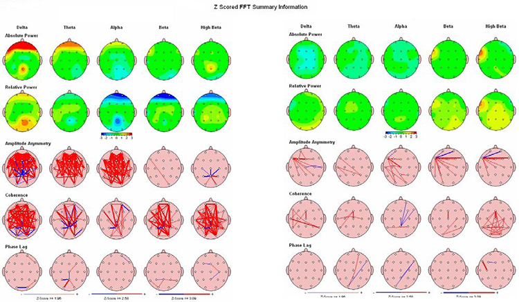 Pre- and post-treatment NeuroGuide QEEG maps showing effects of z-score training