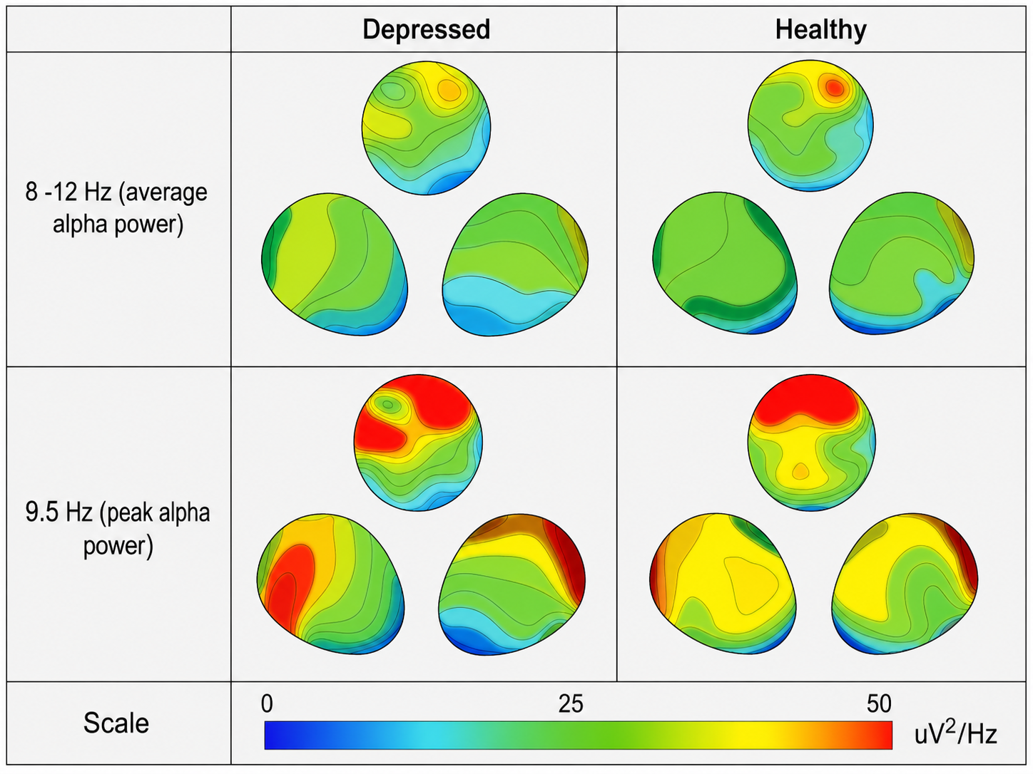 Topographical distributions of alpha power comparing depressed and healthy participants