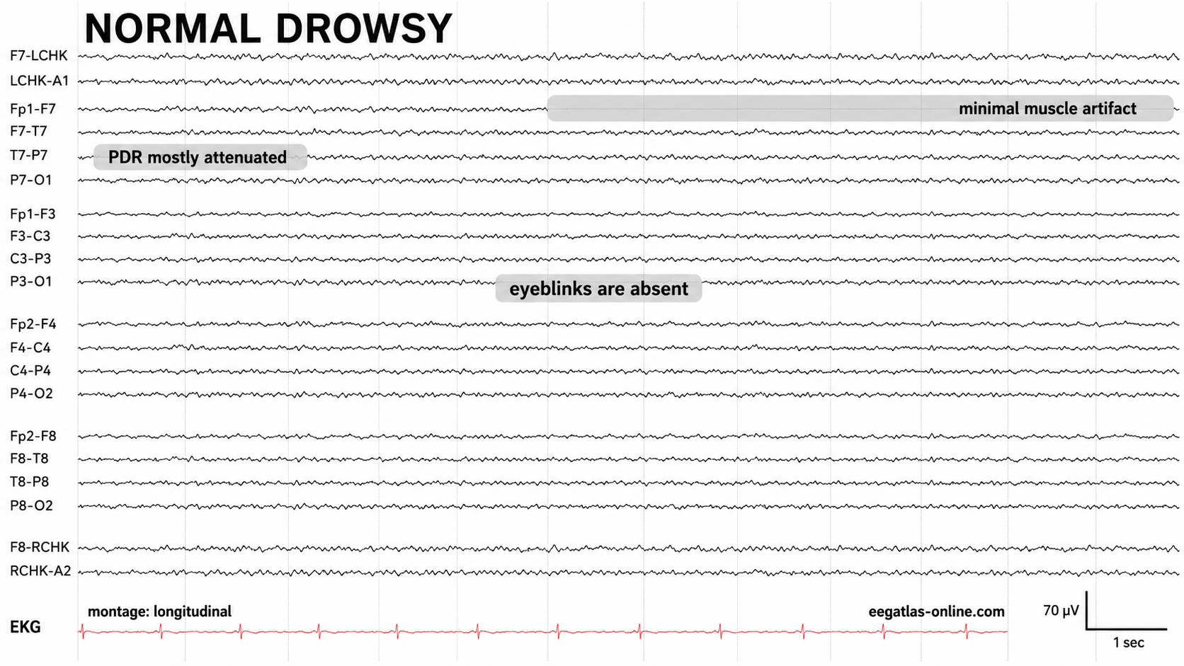 Drowsiness artifact