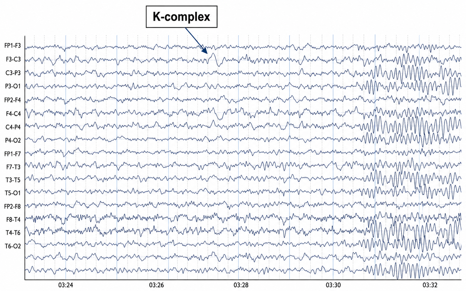 Drowsiness artifact example 2