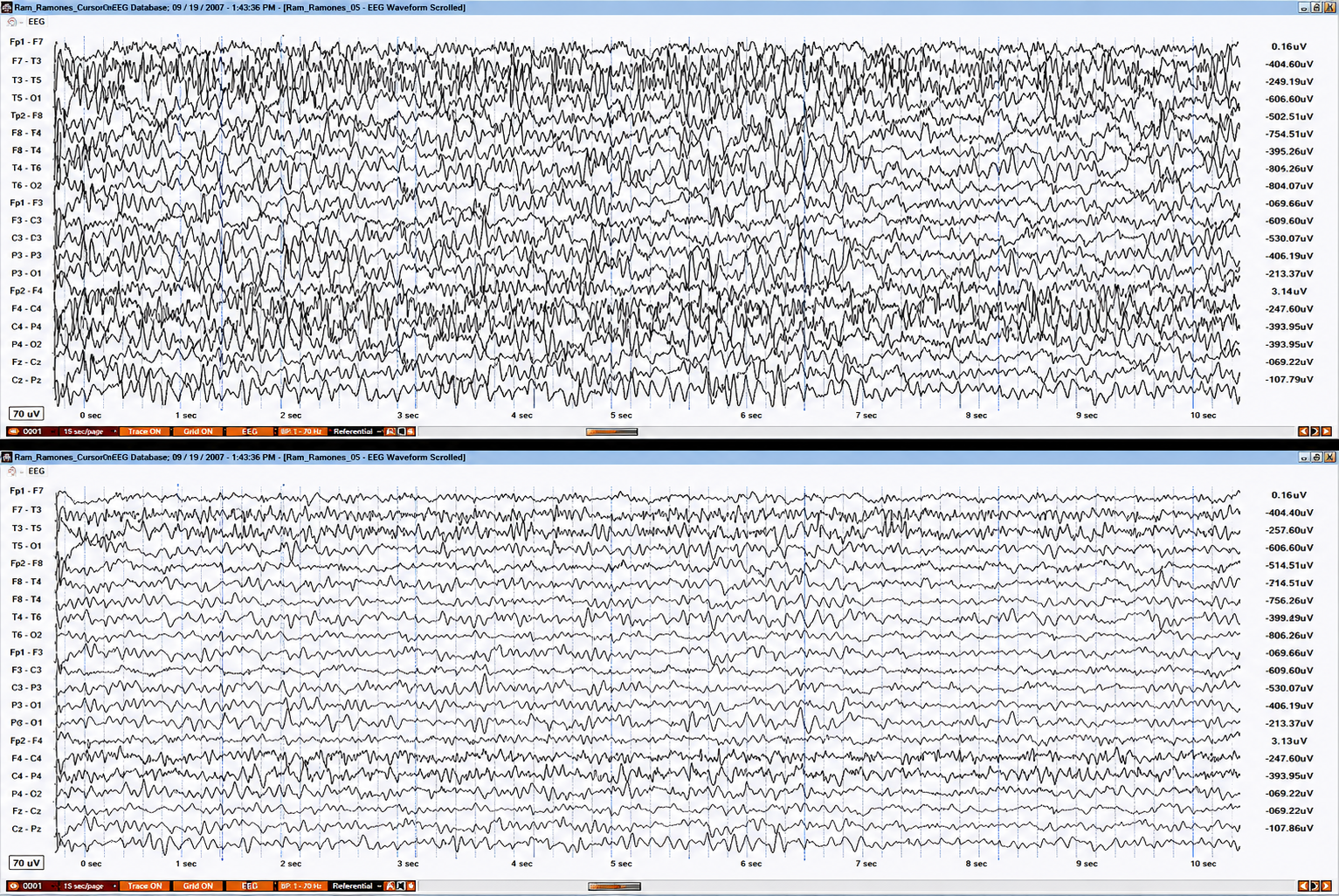 EEG signal at different sensitivities