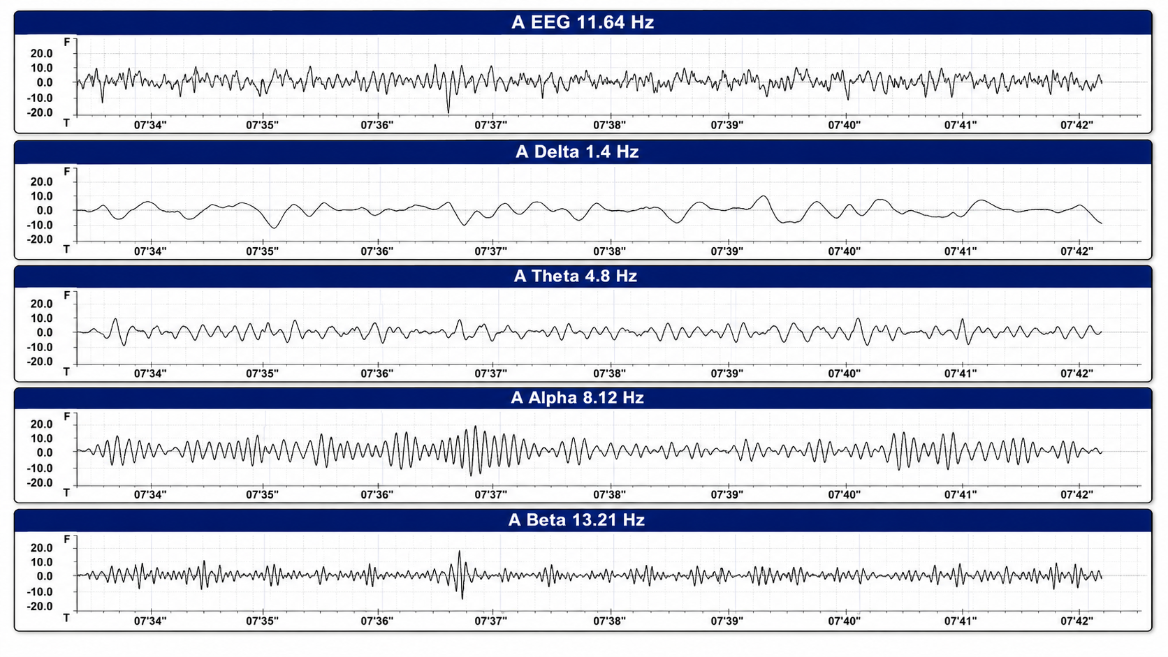 EEG waveforms