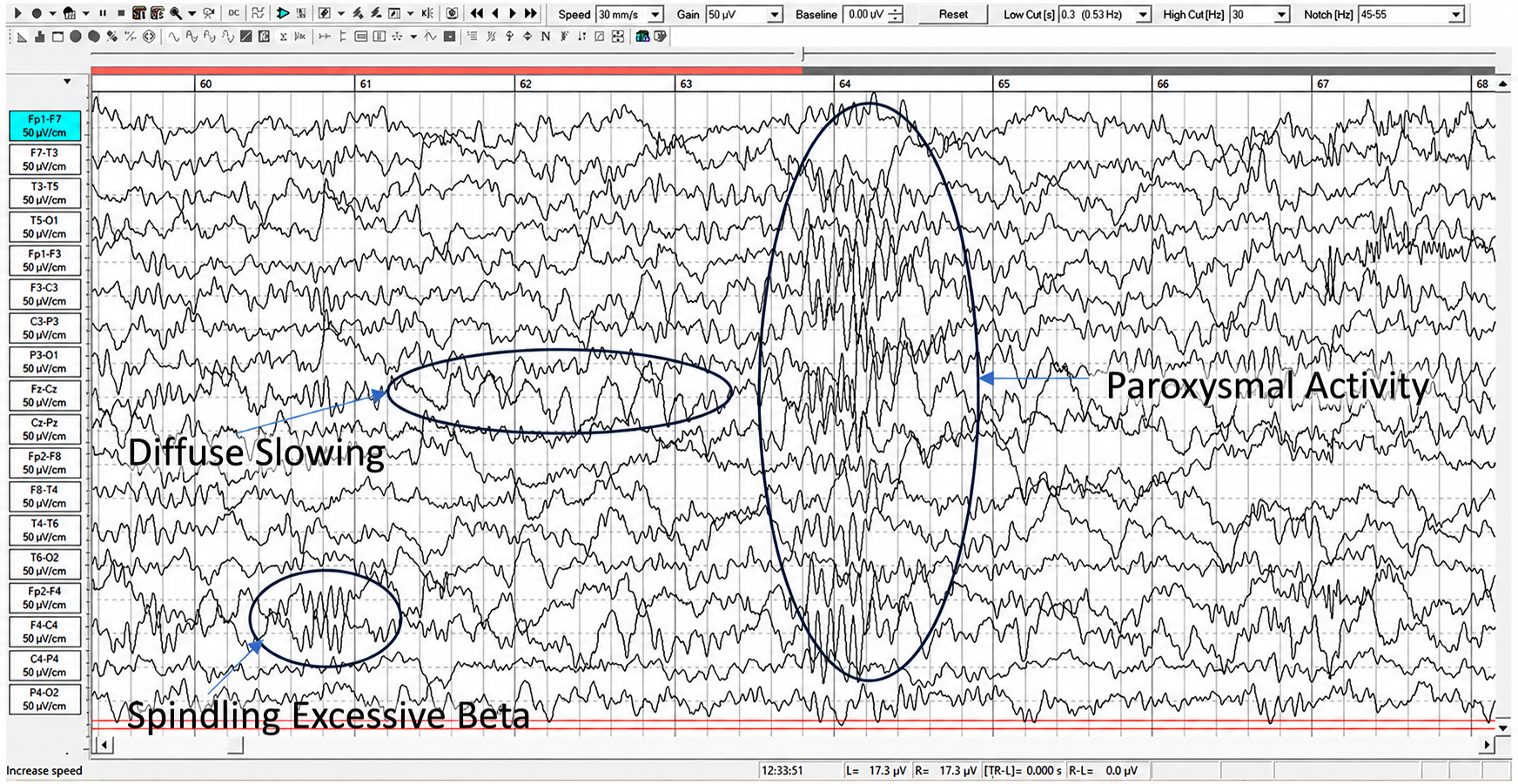 EEG showing diffuse slowing, paroxysmal activity, and spindling excessive beta in a 13-year-old with lead toxicity