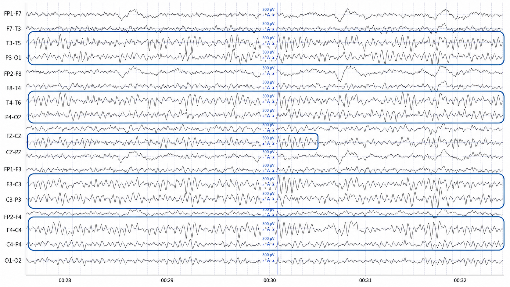 Full scalp EEG in longitudinal montage showing high-amplitude posterior rhythmic activity with several channel pairs circled in blue