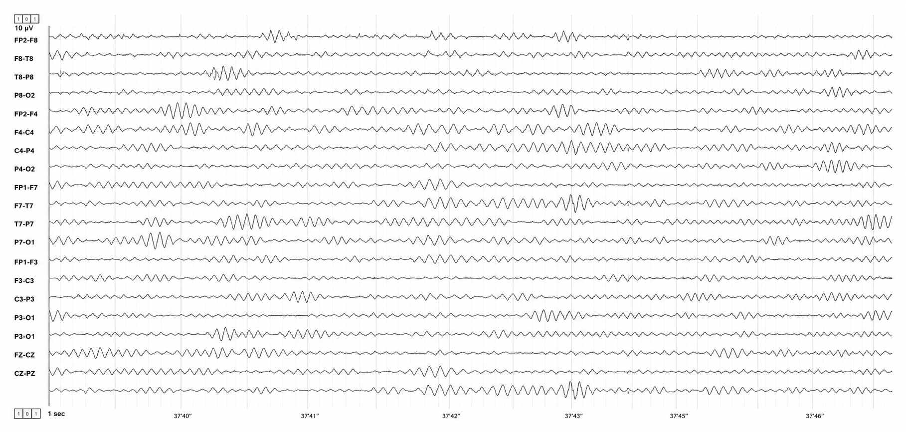 EEG tracing filtered to the 12 to 15 Hz sensorimotor rhythm band