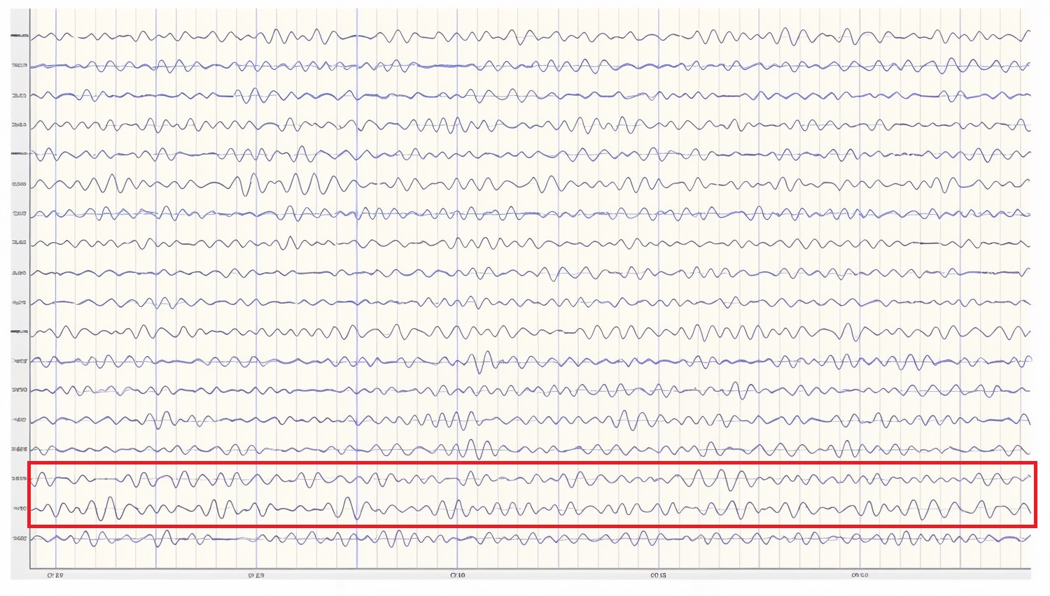Paper EEG recording showing a continuous high-amplitude near-sinusoidal slow rhythm across all channels with two channels boxed in red