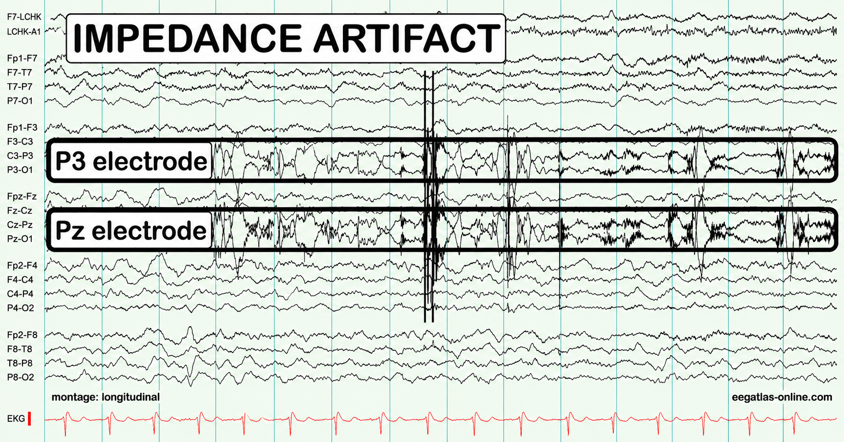 EEG impedance artifact example