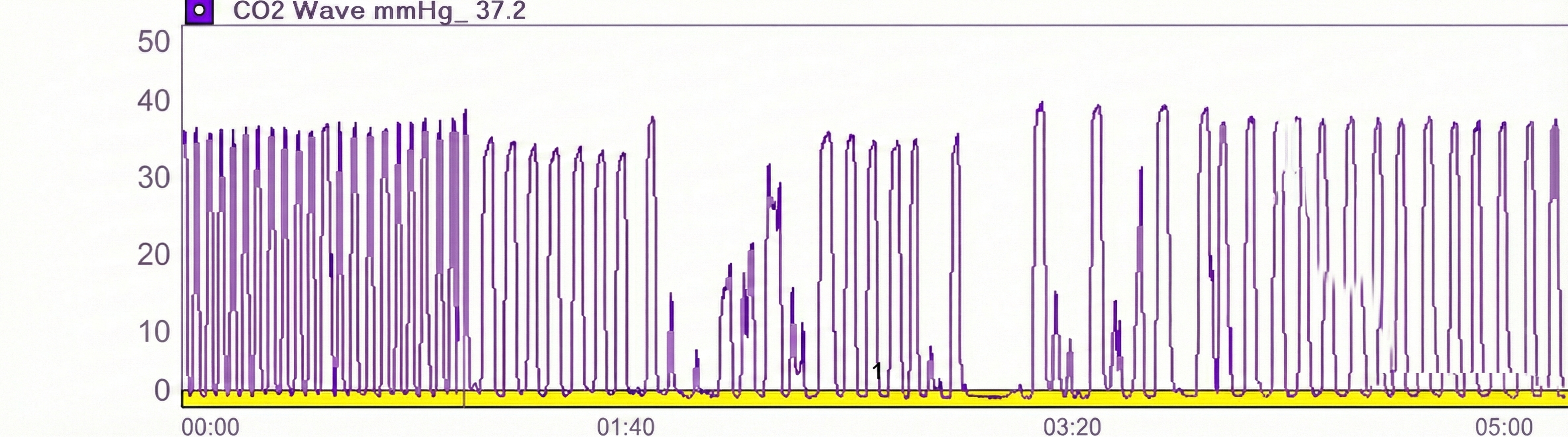 Capnometer waveform