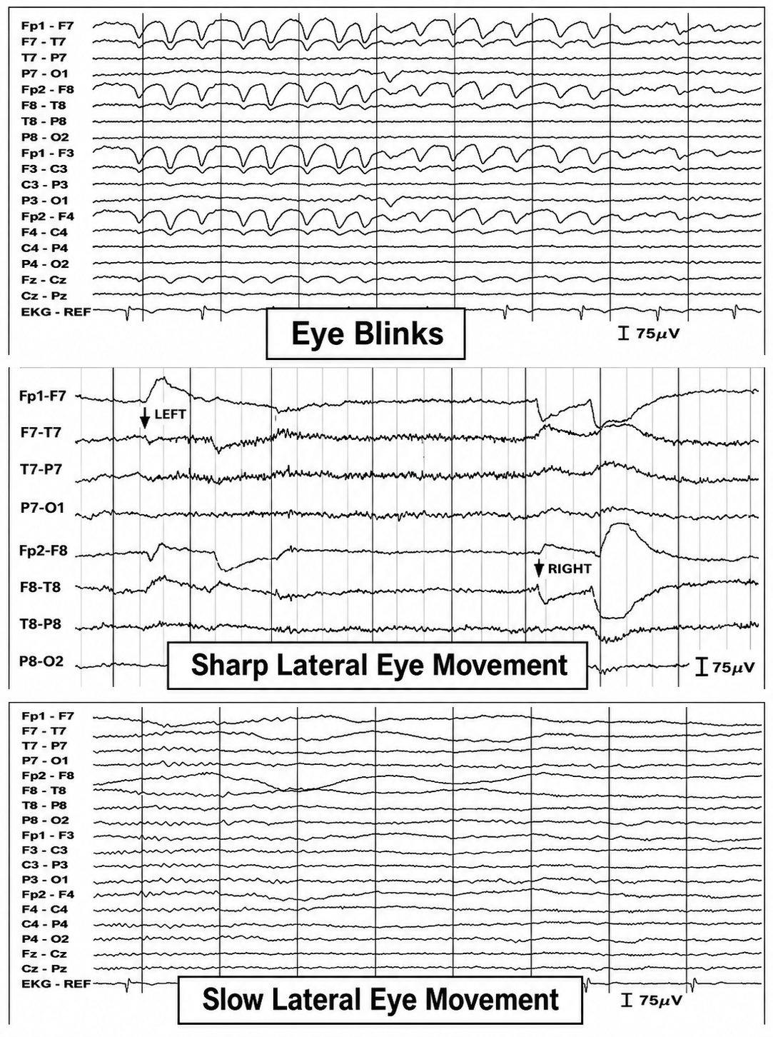 Electro-ocular artifact types