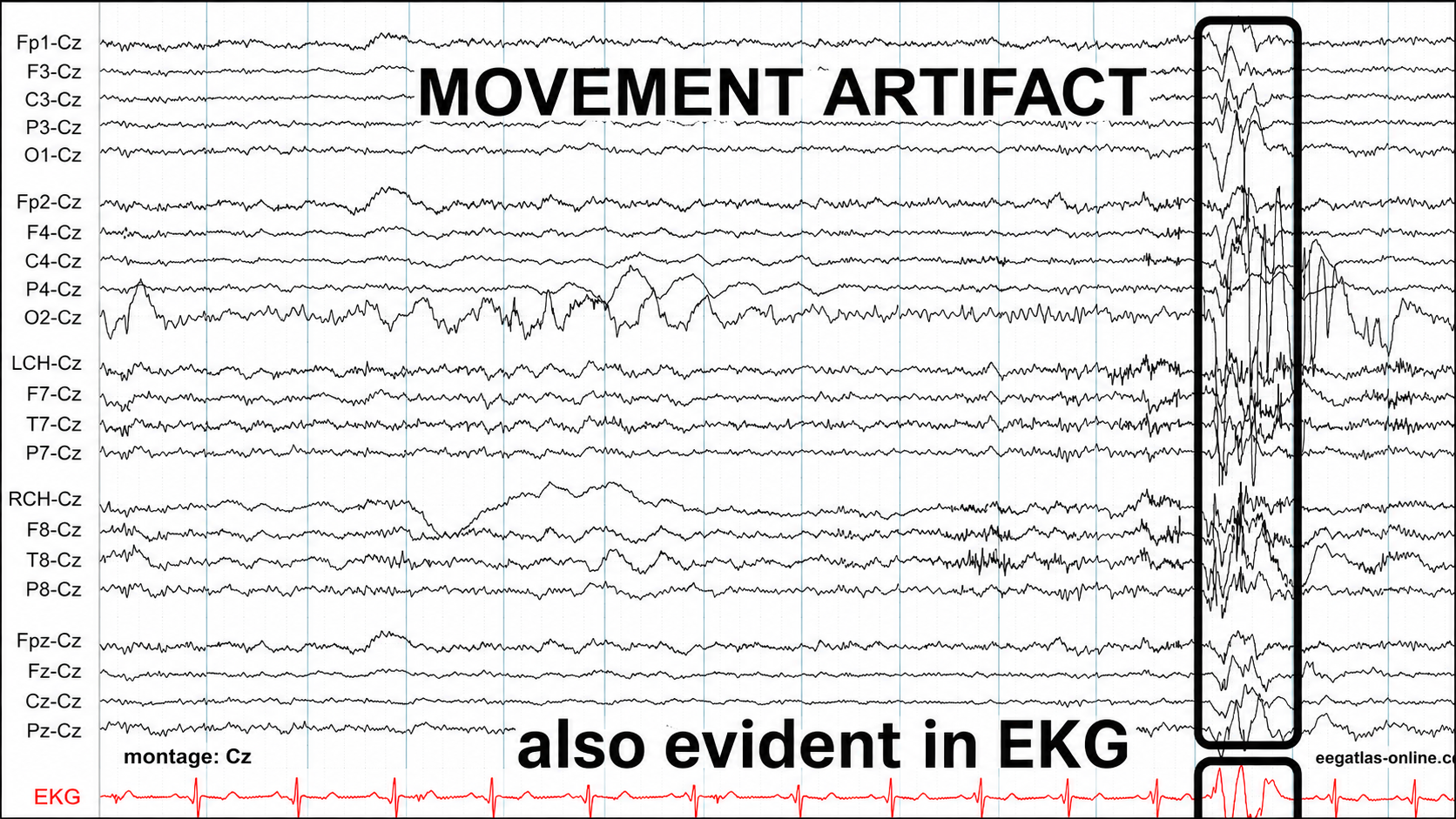 Movement artifact