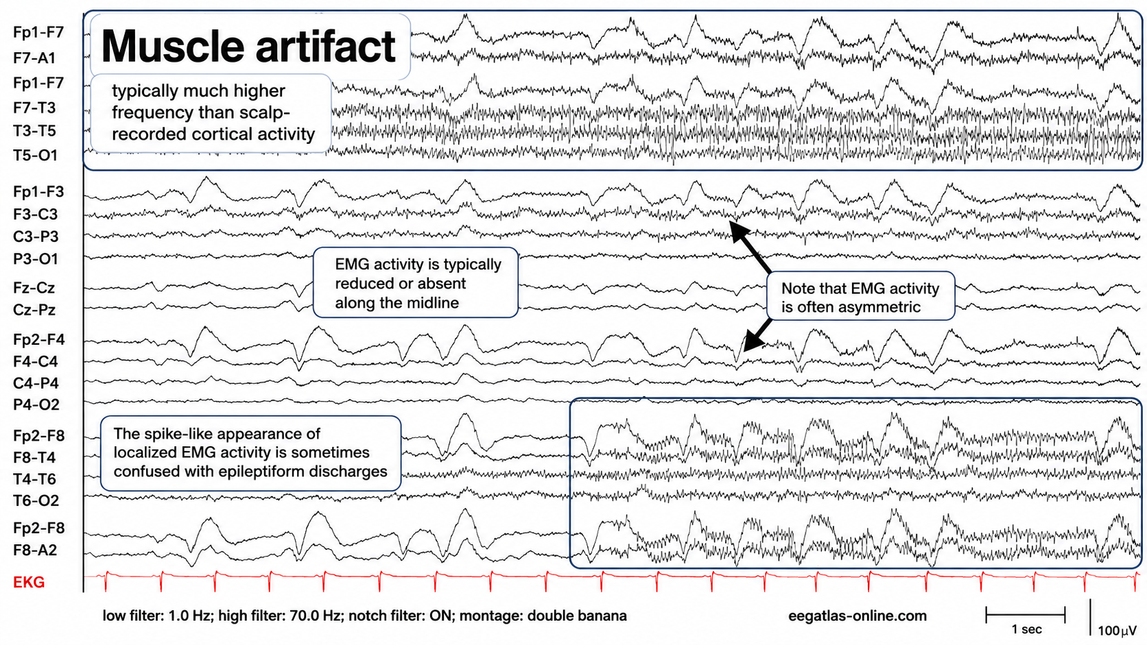 Muscle artifact in EEG