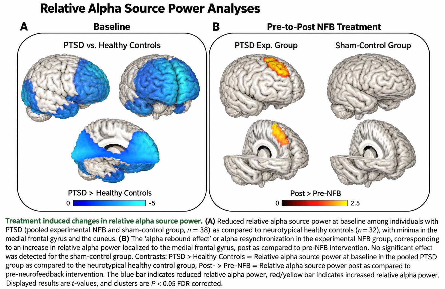 Brain source maps showing reduced relative alpha power in PTSD at baseline and increased medial frontal alpha after neurofeedback but not sham