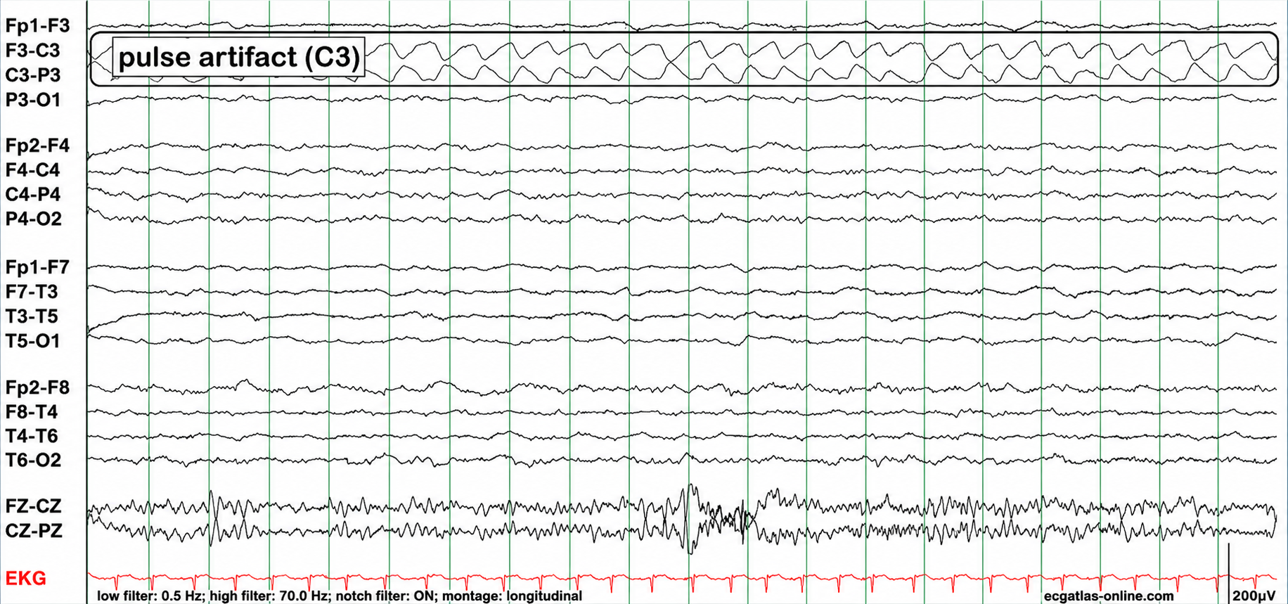 Pulse artifact in EEG