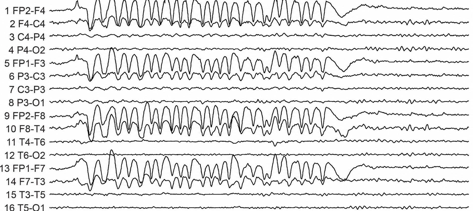 Rapid eye flutter resembling seizure activity