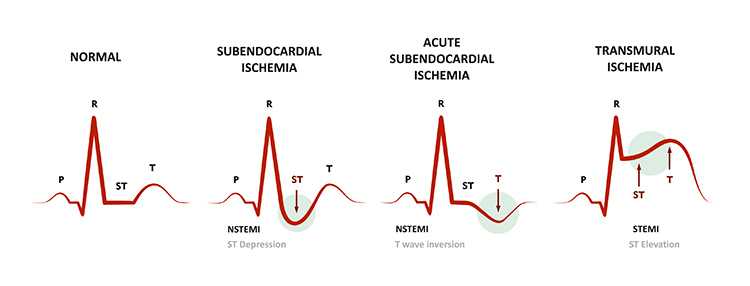 ST segment changes in ischemia