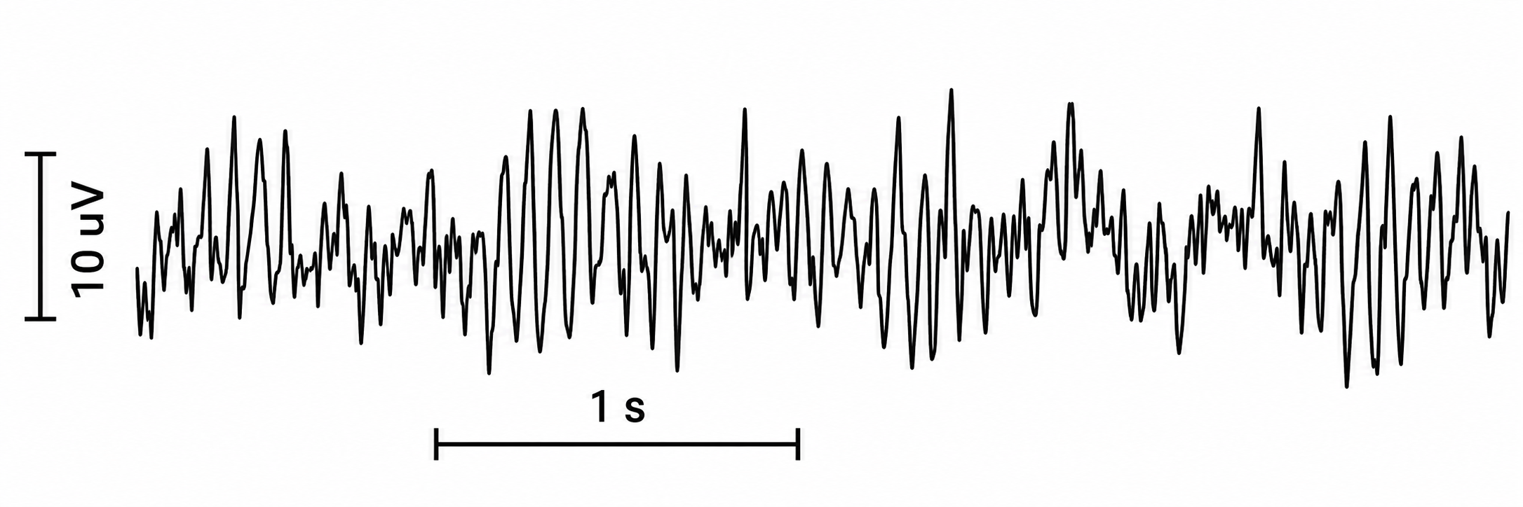 Unfiltered EEG tracing showing sensorimotor rhythm spindles over central sites